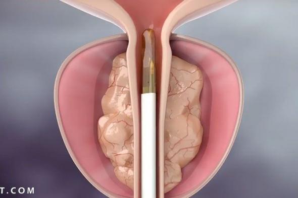 تجربتي مع احتقان البروستاتا