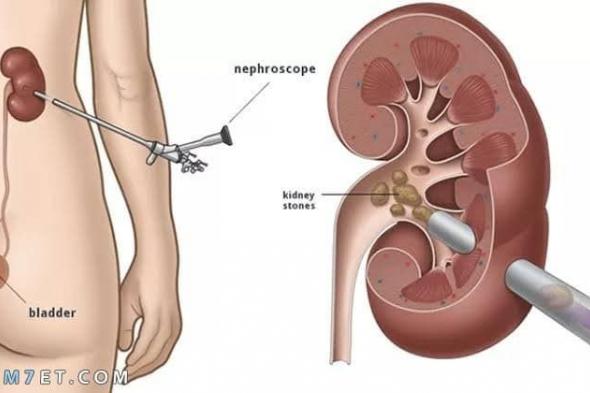 أفضل تمارين لانزال حصوة الحالب والاعشاب الطبيعية