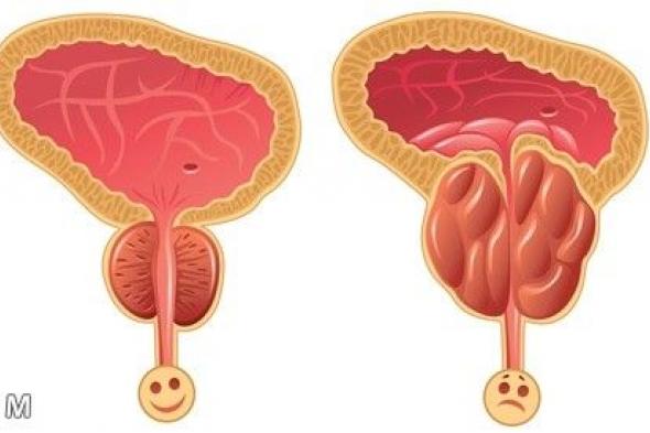 دواء لعلاج البروستاتا | 8 أعراض لتضخم البروستاتا عند الرجال