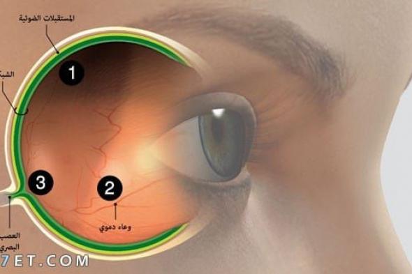ما أسباب التهاب عصب العين وما العلاج