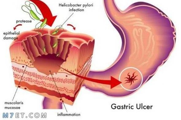 أسباب خروج الدم مع البراز دون ألم هل تشير إلى تدهور الصحة؟!