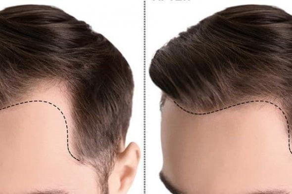 اسعار زراعة الشعر