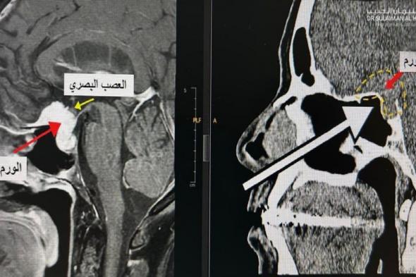 مستشفى الدكتور سليمان الحبيب بالفيحاء في جدة يُنهي معاناة ستينية مع ورم دماغي بقاع الجمجمة