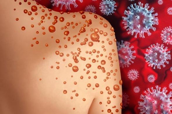 اكتشاف المتغير clade 1b من فيروس mpox لأول مرة في فرنسا