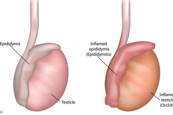 أسباب الم في الخصية اليسرى