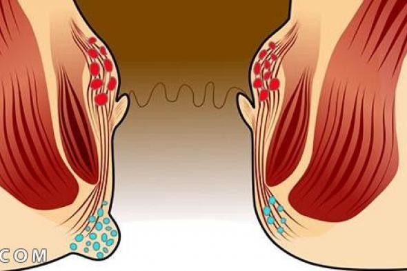 اعراض الناسور ومختلف انواعه وطرق العلاج