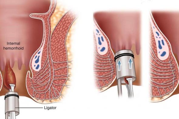 متى يلتئم الجرح بعد عملية البواسير